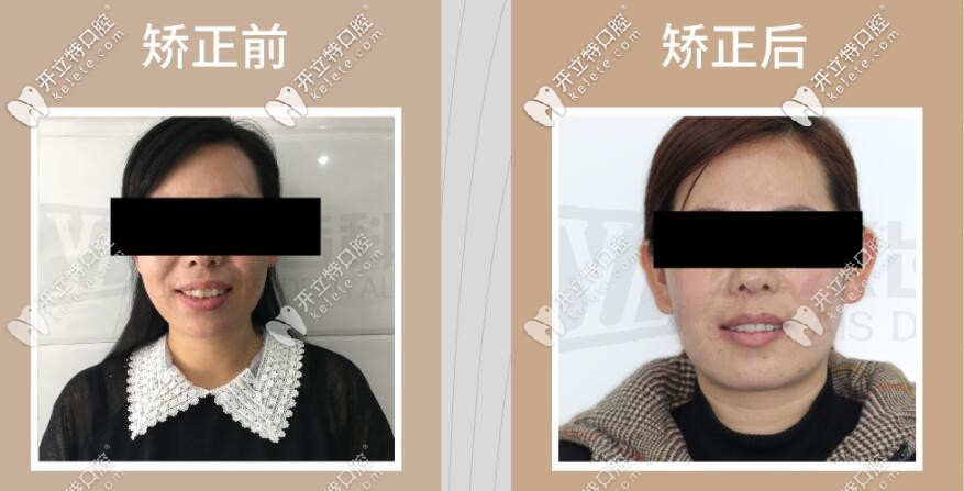 牙齒突出前后對比圖