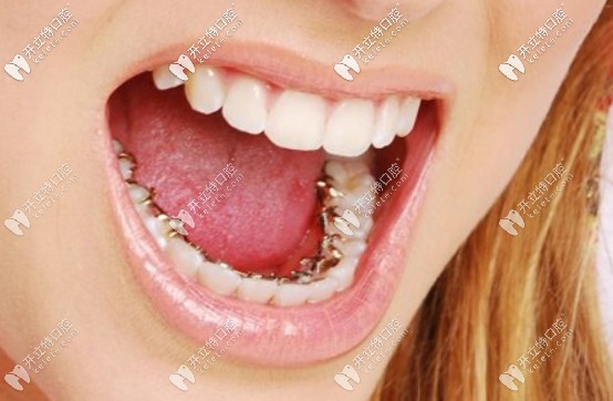 舌側(cè)矯正費用