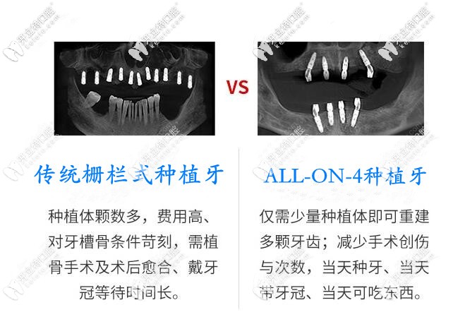長沙德韓ALL-on-4種植VS傳統(tǒng)種植牙