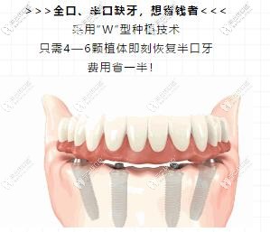 長沙德韓牙科做ALL-on-4種植牙
