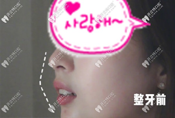 西安牙友反饋在美奧口腔做深覆合齙牙糾正后，側(cè)顏絕了