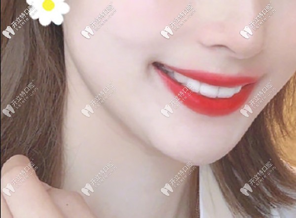 牙齒矯正牙齒排齊