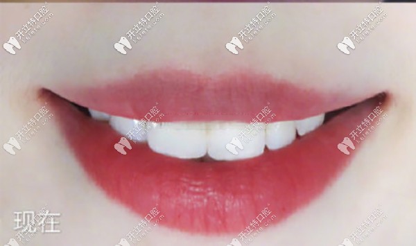 齙牙矯正結(jié)束