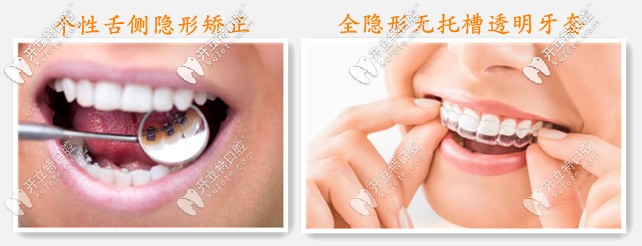全隱形牙齒矯正器的分類