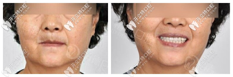 吐槽下北京精德口腔做allon4全口種植牙的弊端,那就是價格…