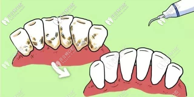 超聲波潔牙圖示