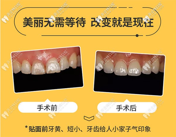 為美發(fā)問(wèn)：重慶渝中區(qū)的美奧口腔做美加超薄牙貼面如何？