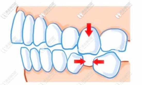 缺牙不種的后果