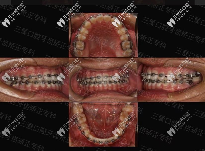 地包天矯正前后對比圖