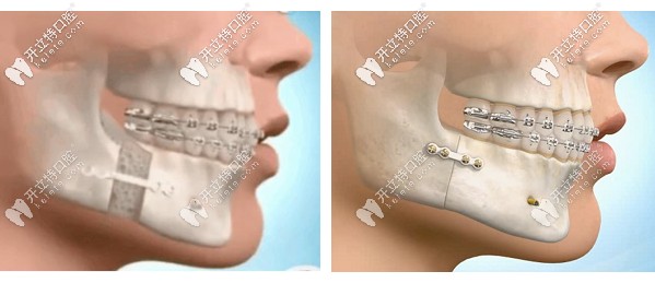 廣州廣大醫(yī)院的口腔正頜手術(shù)價(jià)格大概多少錢,你不想看看？