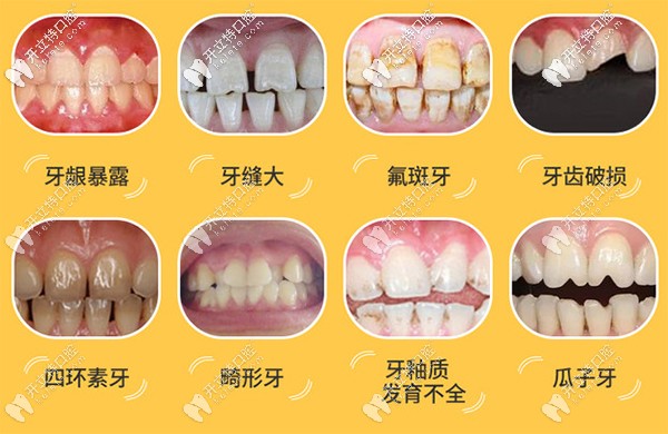 牙貼面能解決哪些牙齒問題