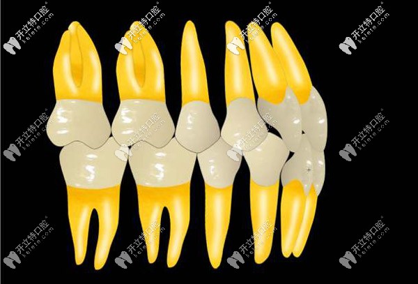 骨性Ⅱ類錯頜?安利你了解下tweed方絲弓矯治技術(shù)