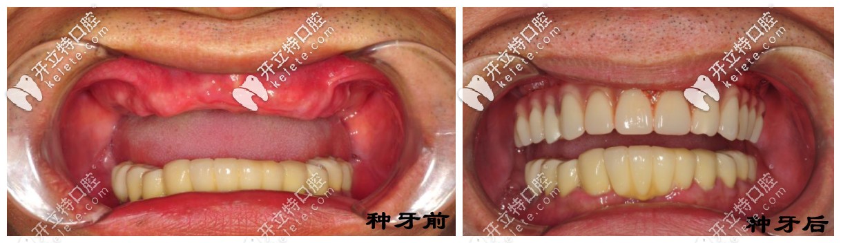 種半口牙前后對比