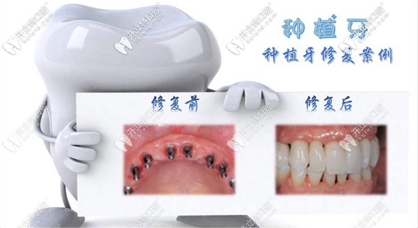 在菏澤做種植牙多少錢一顆？