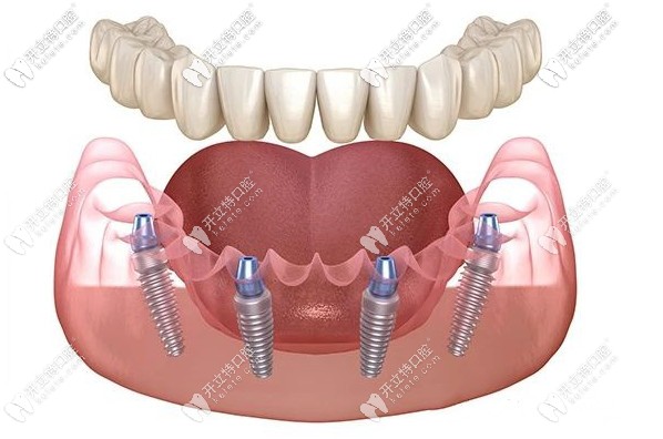 “我太想知道南京做all-on-4種植牙哪家牙科好了！”