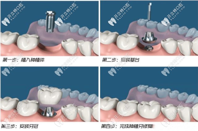 種植牙的流程