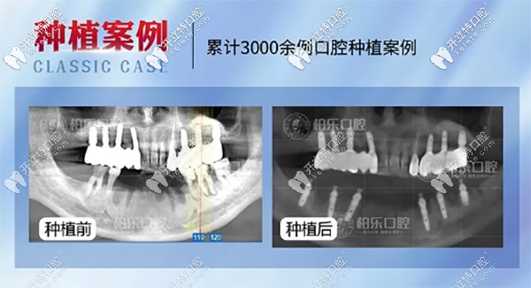 專訪柏樂口腔南湖總院實力派種植醫(yī)生崔金禮-種植修復(fù)