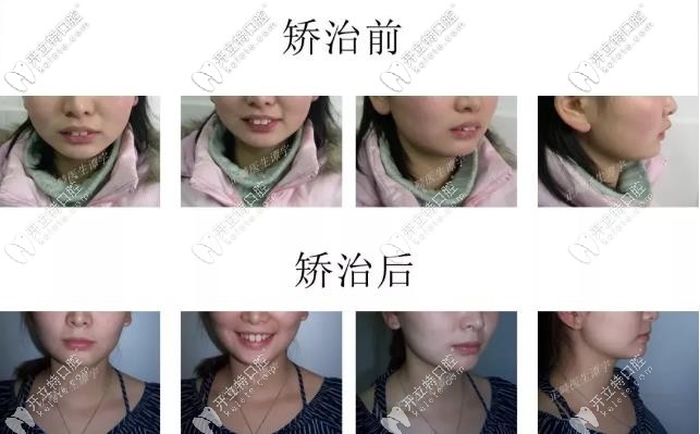 兔牙小妹妹--牙齒矯正對(duì)比圖