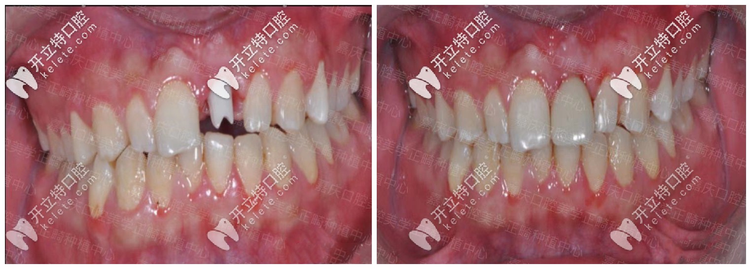 單顆種植牙修復(fù)<span style=