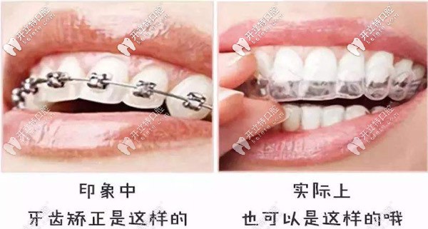 告別鋼牙妹，別錯過隱形矯正哦