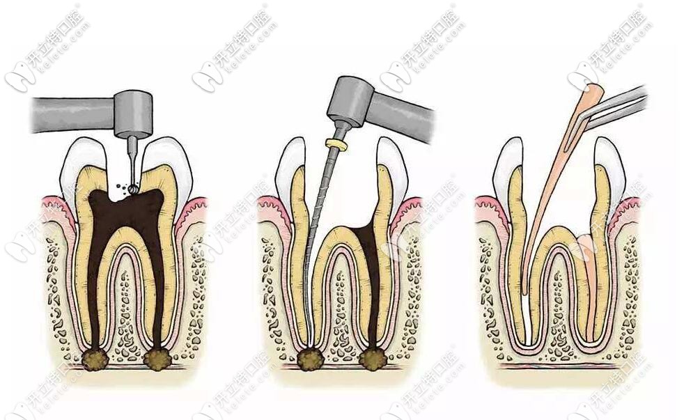 根管治療 根管治療