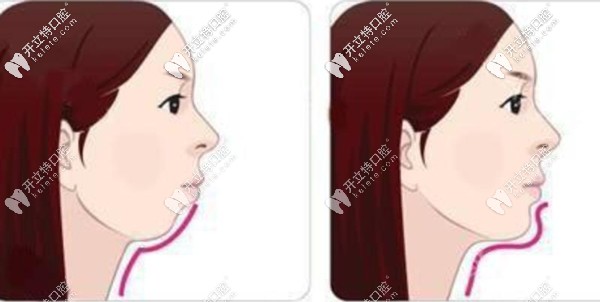 A6隱形牙套可以打開咬合前導下頜