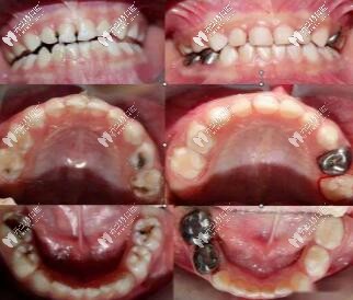 寶媽說兒童補(bǔ)牙被忽悠做牙冠,小孩有必要做乳牙預(yù)成冠嗎