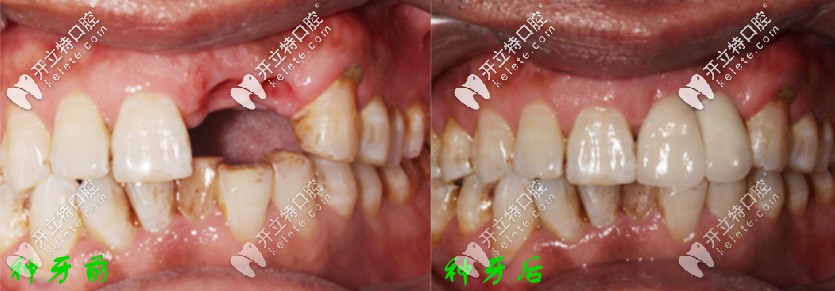 種牙前后對比