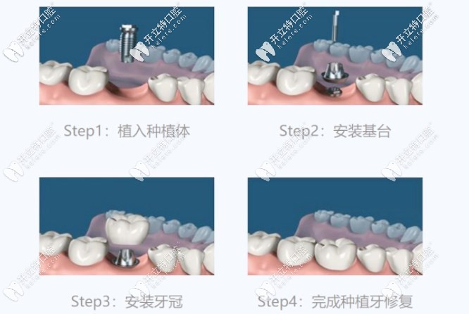 種植牙的簡單流程