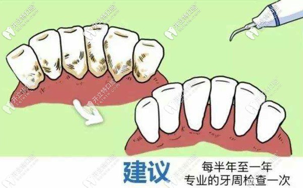 牙周固定術(shù)