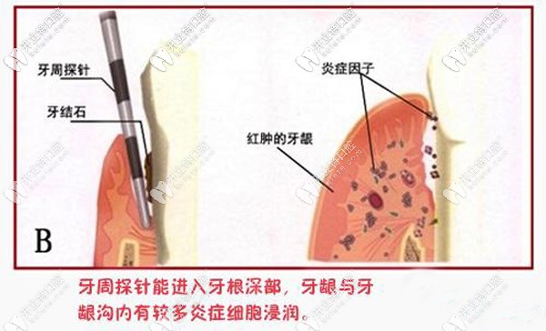 牙周治療固定術(shù)