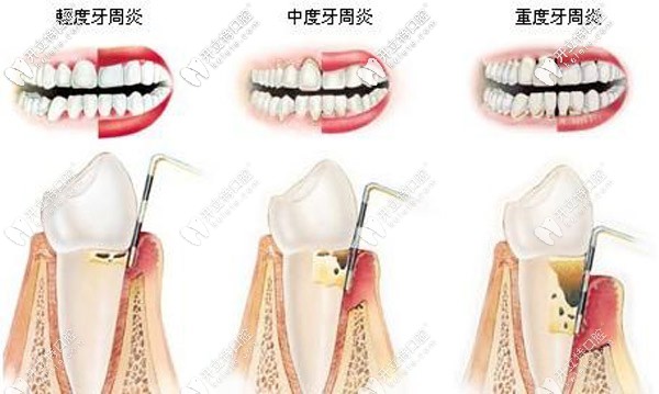 上海哪里有丹麥水冷激光治療，大概需要多少費(fèi)用？