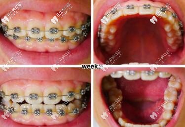 牙周炎牙齒矯正經(jīng)歷