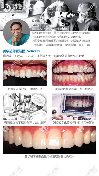精德口腔解德勇院長的牙齒貼面案例