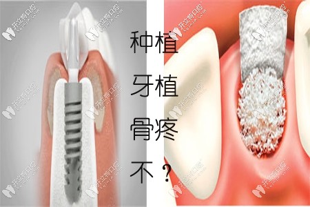 天哪！種植牙填骨粉太疼了？上門牙種植一定要植骨粉嗎
