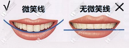 微笑線設(shè)計(jì)前后對(duì)比圖