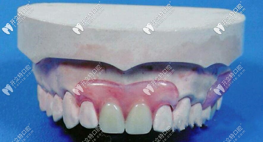 我老爸當(dāng)初用的就是類似下邊的這個義齒