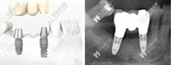 這是一個缺三顆牙種2顆植體的案例圖
