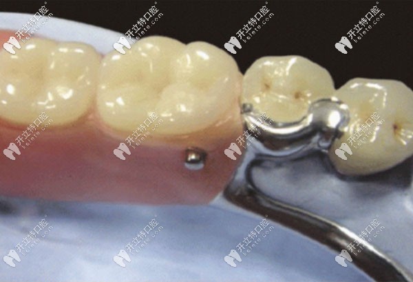 塑鋼牙和烤瓷牙哪個好以及它們的區(qū)別,都在這里