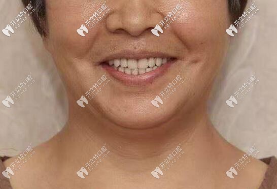 老媽做了全口種植牙后的效果圖