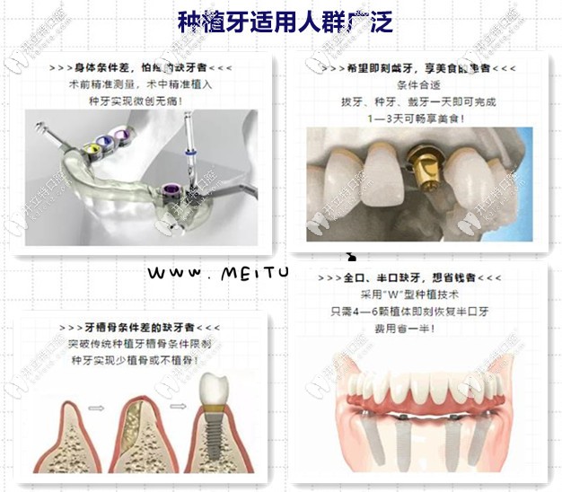 種植牙的優(yōu)勢(shì)及適應(yīng)人群