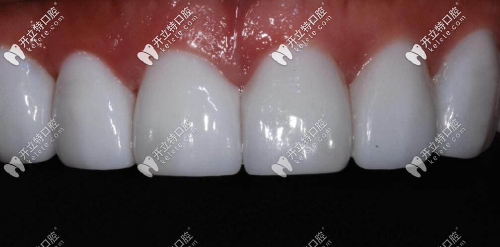 瑞士珍珠白納米水晶瓷貼面怎么樣？和玻璃瓷貼面哪個(gè)更好