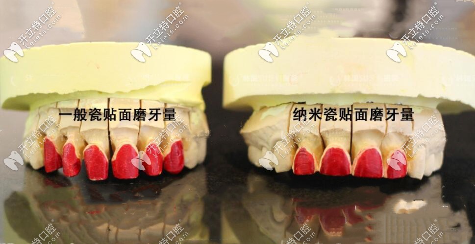 納米水晶瓷貼面磨牙量少