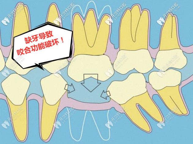 缺牙導致咬合功能破裂