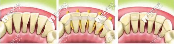 牙齒用手晃有點松動的你,這松牙固定術(shù)簡直是“救星”