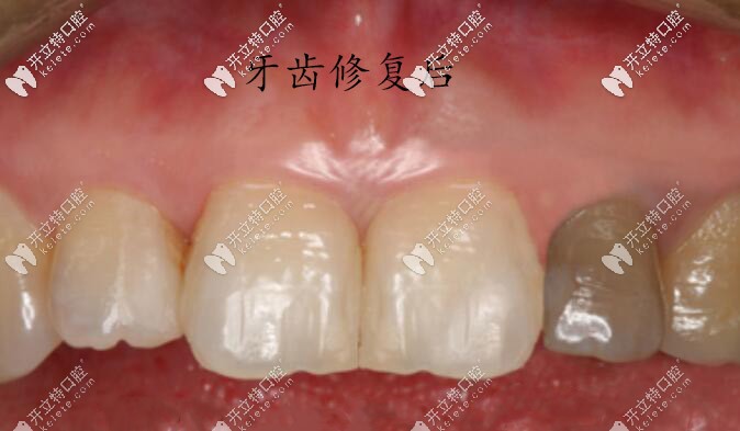 牙齒修復后