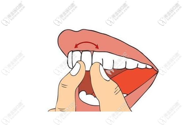 松牙固定術一般固定多久