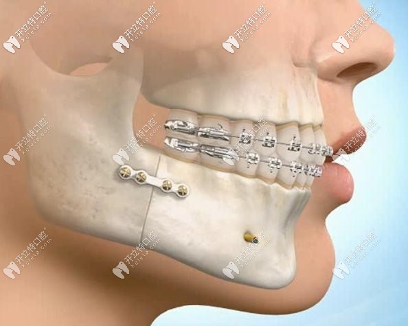 曲靖第一人民醫(yī)院口腔科價(jià)格表!種植牙5800元,門診4樓掛號(hào)