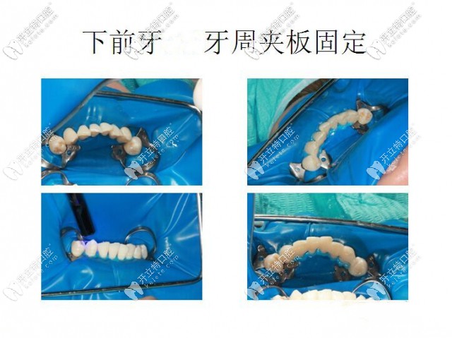下前牙牙周夾板固定