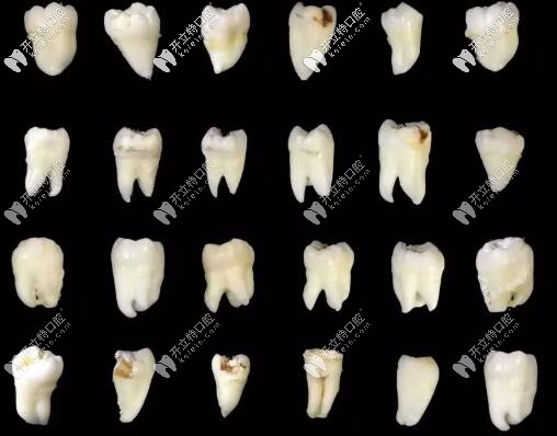 智齒的各種形態(tài)